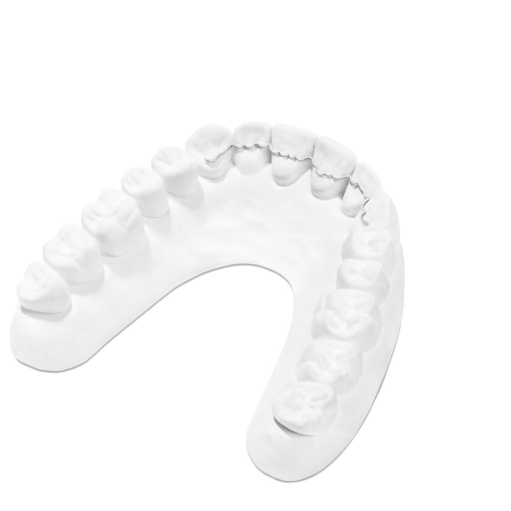 weißes Gebissmodell mit Retainer im Unterkiefer