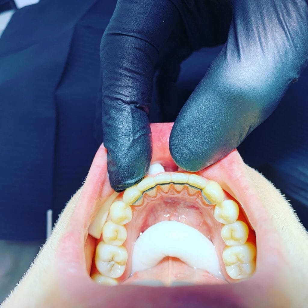 Festsitzender Retainer im Oberkiefer aus dünnem Draht