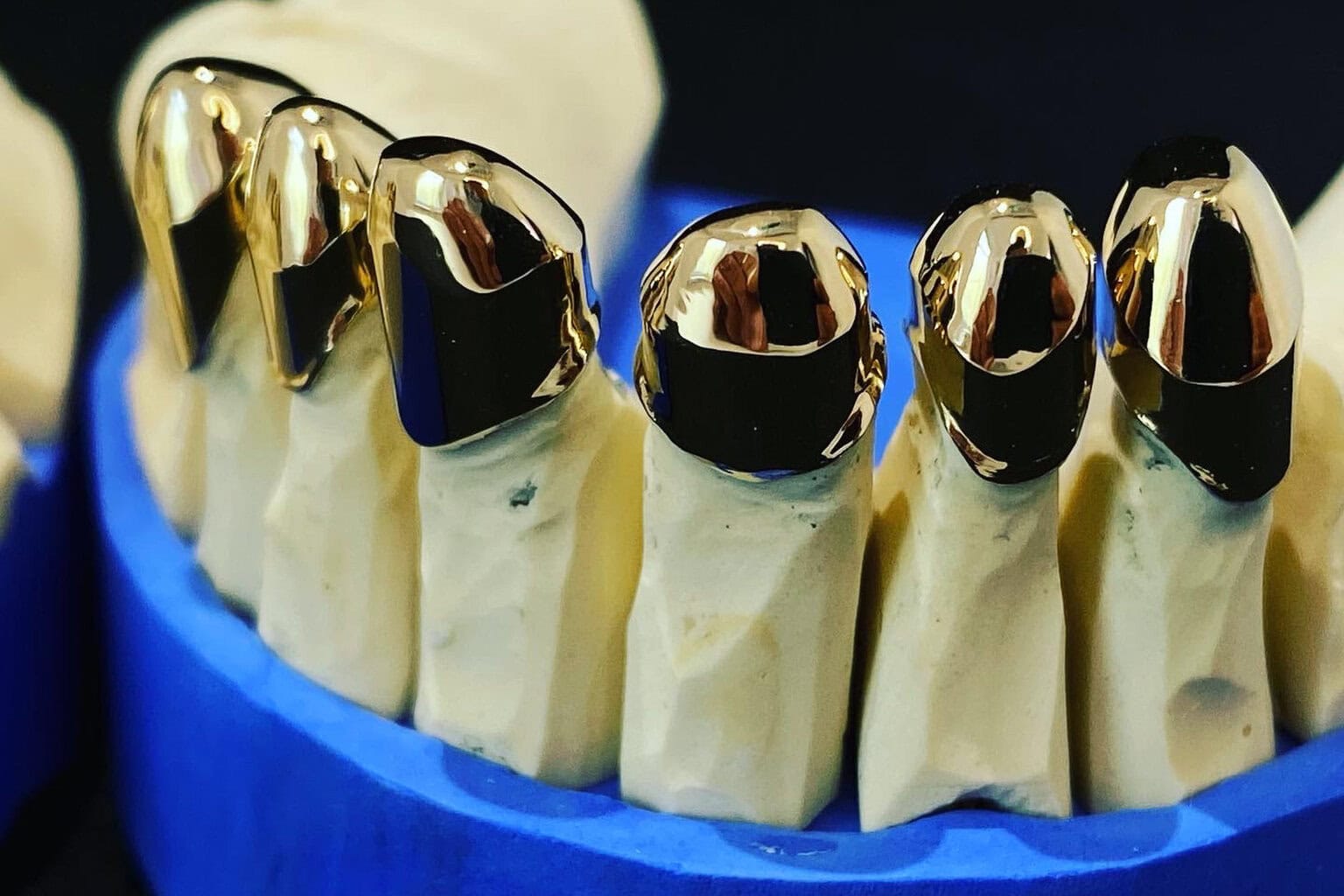 Goldzähne anhand Gebissmodell